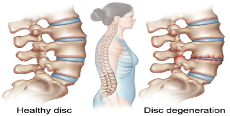 Sakit tulang belakang tengah
