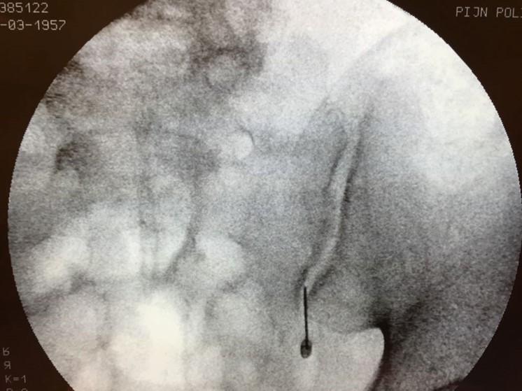 Sacroiliac (si) joint arthropathy