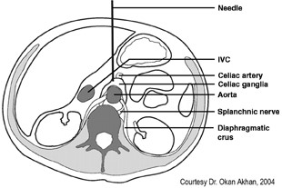 gangglion celiac blockade-2