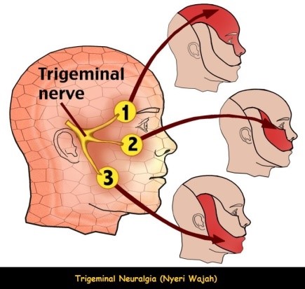 Trigeminal Neuralgia