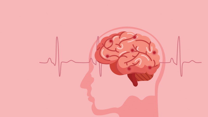 Waspadai Gejala Penyebab Stroke Serta Pencegahannya Rumah Sakit Emc