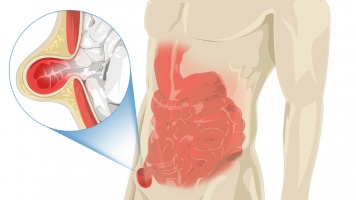 Penyakit Hernia, Tidak Berbahaya Namun Jangan Anggap Sepele image